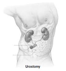 Graphic of a Urostomy Stoma